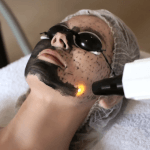 carbon-peeling
